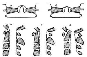Рис. 1.5. Схематическое изображение взаимоотношений верхних шейных позвонков при переломе Джефферсона