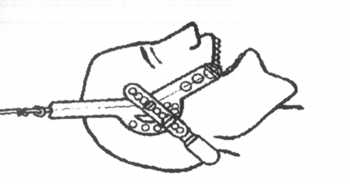 Рис. 2.18.1. Схема фиксации головы специальным устройством для вытяжения шейного отдела позвоночника за основание черепа