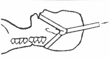 Рис. 2.18 2. Схема фиксации головы больного лямками для вытяжения шейного отдела позвоночника за основание черепа