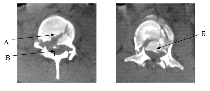 Рентгенологические признаки перелома позвоночника