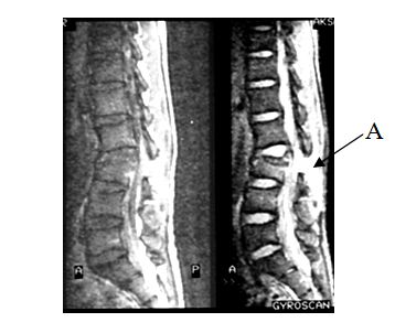 Рентгенологические признаки перелома перелом позвоночника