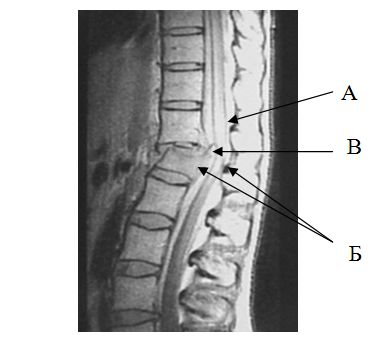 Рентгенологические признаки перелома перелом позвоночника
